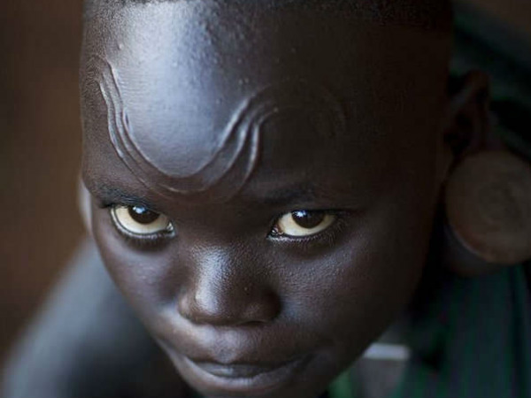 11. సూడాన్ లో ఆచారం ప్రకారం వారు గాయపడినప్పుడు ఎలాంటి వైద్యం చేయకూడదు.