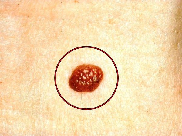 4. మౌత్ మరియు స్కిన్ క్యాన్సర్లు: