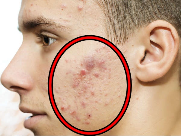 నల్ల మచ్చలను నివారిస్తుంది