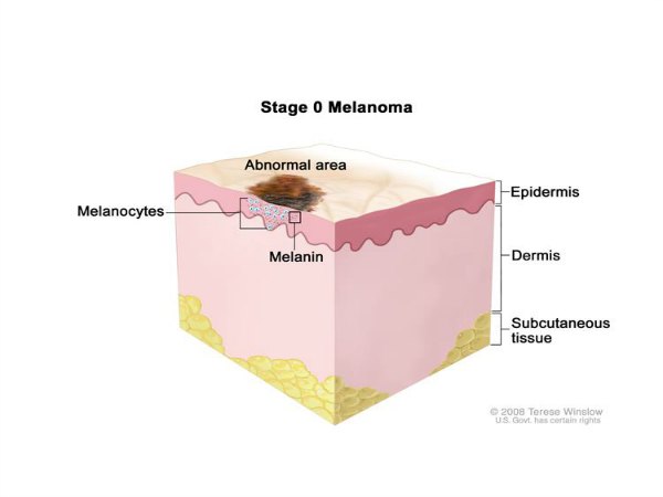 The Complete Guide to Melanoma: Symptoms