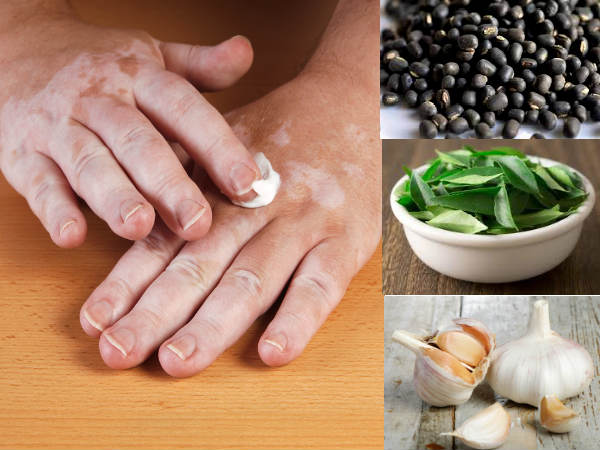 10 Amazingly Effective Home Remedies To Treat Leucoderma 10 Amazingly Effective Home Remedies To Treat Leucoderma