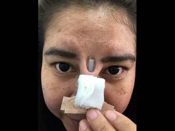 ఈమె ఆమె యొక్క ముక్కుకు మంచి రూపుని తెప్పించాలని భావించింది.