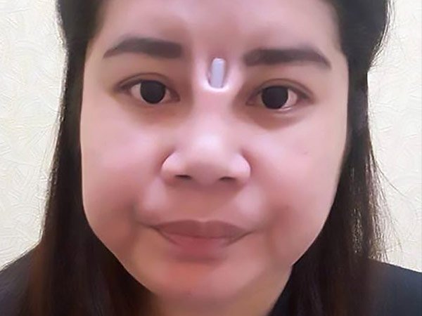 ఈమె అమర్చుకున్న ఇంప్లాంట్ చర్మాన్ని చీల్చుకుంటూ బయటకు వచ్చింది :