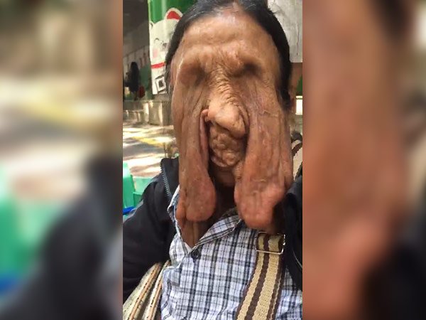 న్యూరోఫిబ్రోమాటిసిస్