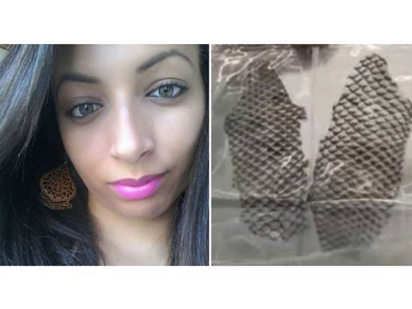 Real-life Story Of The Girl Born Without A Vagina Who Created One Using Fish Skin!, Real-life Story Of The Girl Born Without A Vagina Who Created One Using Fish Skin!,