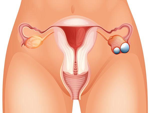 ఒవేరియన్ క్యాన్సర్ రకాలు: