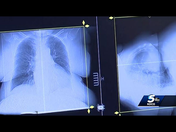 క్రమంగా ఈ కాన్సర్, అతని శరీరంలోని ఇతర అవయవాలకు వ్యాపించింది ..