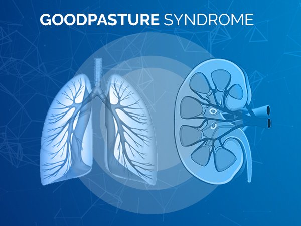 Goodpasture Syndrome