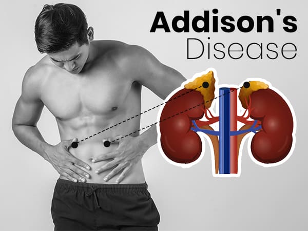 Addisons Disease Addisons Disease