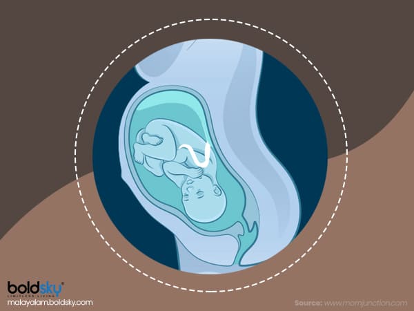 బ్రీచ్ స్థితిలో ఉన్నప్పుడు