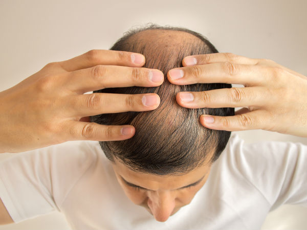 బట్టతల పరిష్కారం