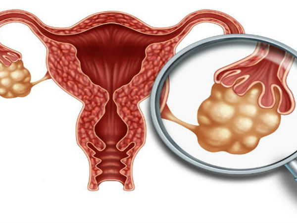 గర్భాశయంలో తిత్తులు ఉండవచ్చు