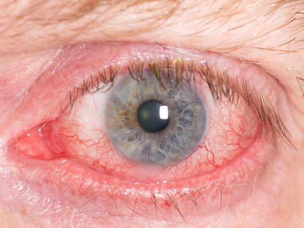 హైఫిమా (Hyphema)