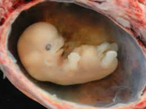 గర్భస్రావం ఎందుకు జరుగుతుంది?