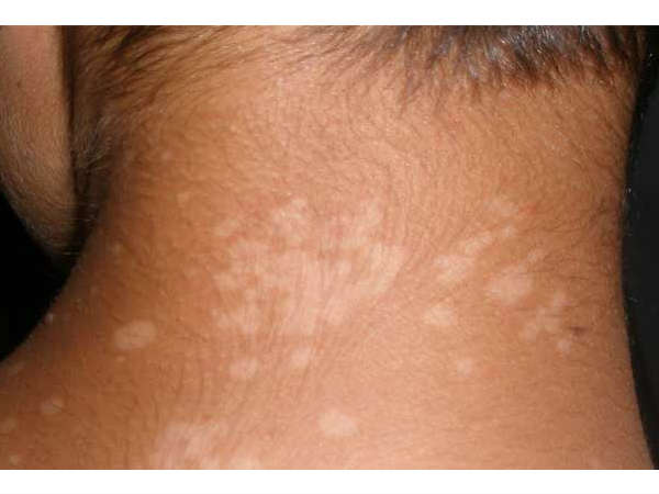 వైట్ ప్యాచ్ లు