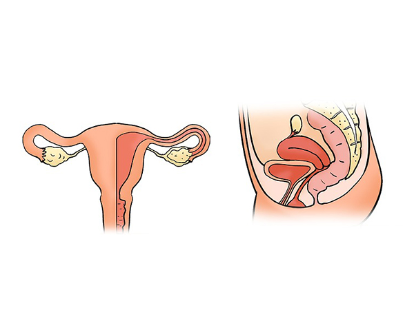 గర్భాశయ క్యాన్సర్ కు ఇతర లక్షణాలు