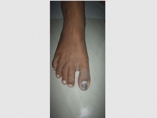 ఆకస్మిక మెలనోమా