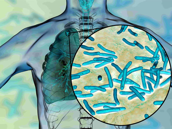 సంతానోత్పత్తి లోపం మరియు క్షయ