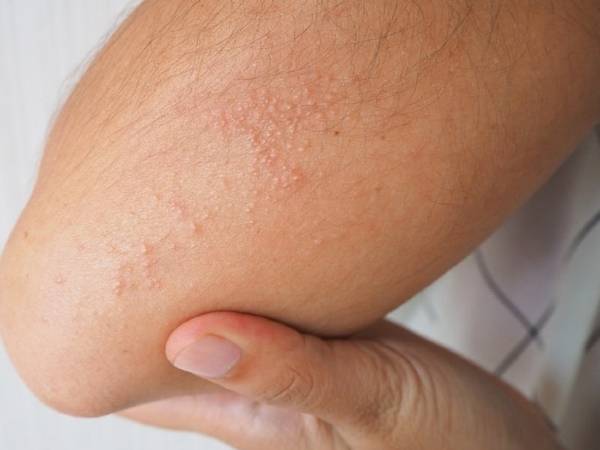 ఏ రకమైన సోరియాసిస్ కనుగొనబడింది?