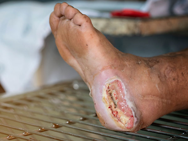 Evaluation and Treatment of Diabetic Foot Ulcers