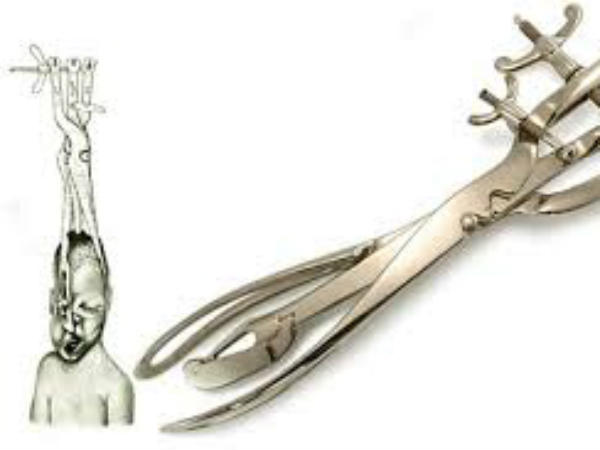 మహిళ యొక్క కటిపై తీవ్రమైన గాయం మరియు ఒత్తిడితో గర్భస్రావం