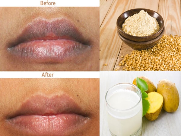 Ways to get rid of darkness around the mouth Ways to get rid of darkness around the mouth
