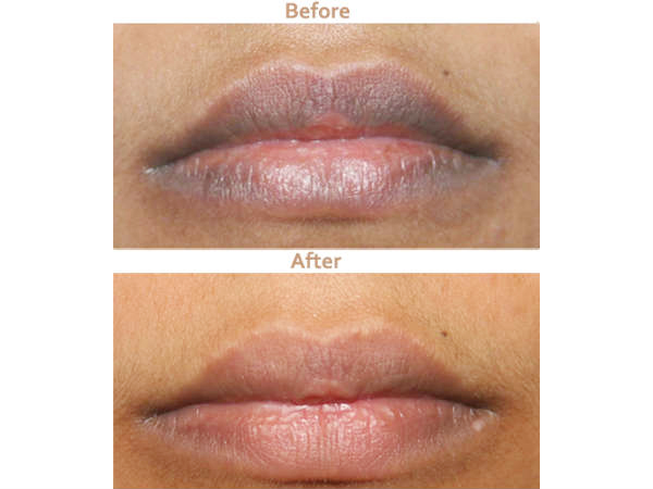 Ways to get rid of darkness around the mouth Ways to get rid of darkness around the mouth