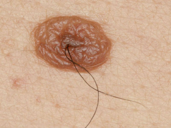  శరీరంలో మచ్చలపై జుట్టు