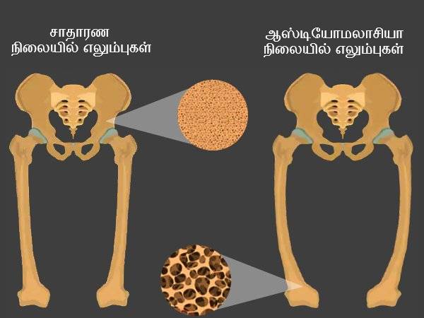 రికెట్స్
