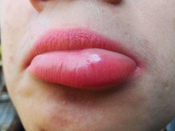 పెదవుల వాపు