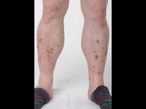 కాళ్ళపై ఎర్రటి దద్దుర్లు కాళ్ళపై ఎర్రటి దద్దుర్లు