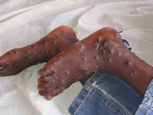 మంకీపాక్స్ వైరస్లు ఎన్ని రకాలు ఉన్నాయి?