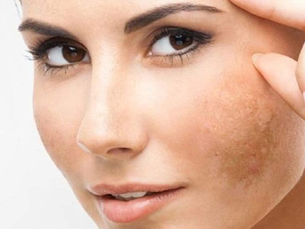 చర్మం నల్లబడటం తగ్గించడం
