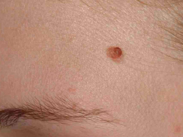 గాయం మాదిరిగా..