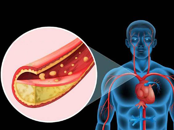 జీవనశైలి మార్పులు సరిపోకపోతే