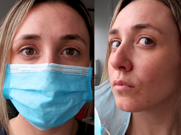 Can Wearing Mask Lead to Headache? and How to Prevent in Telugu Can Wearing Mask Lead to Headache? and How to Prevent in Telugu