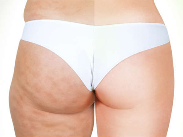  పురుషుల కంటే స్త్రీలకు సెల్యులైట్ ఎందుకు ఎక్కువగా ఉంటుంది?