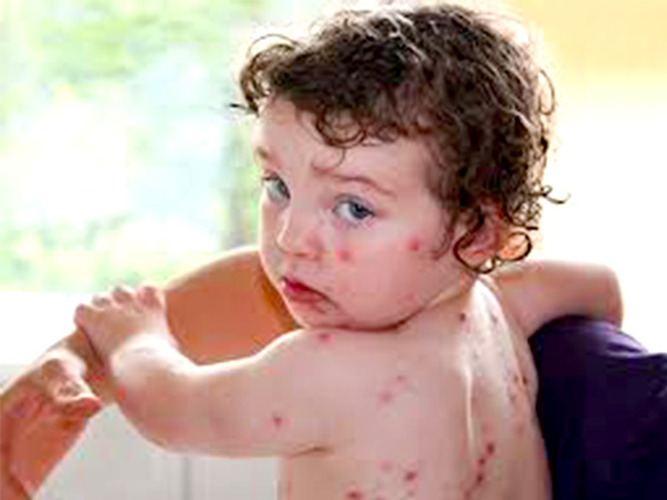 What is tomato fever: Know causes, symptoms, treatment and prevention in Telugu