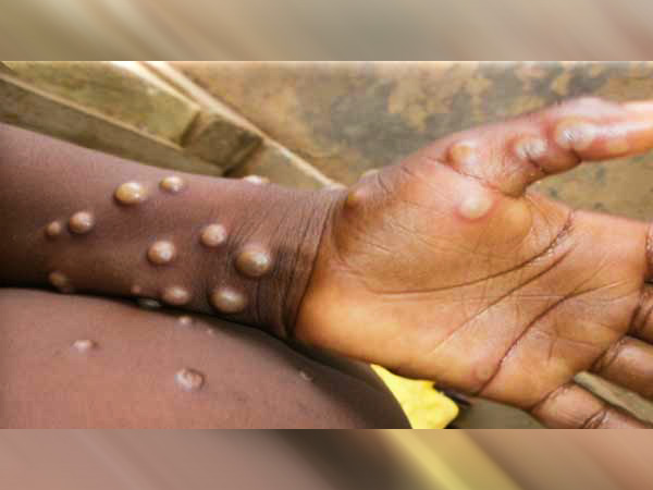 మంకీపాక్స్ భయాందోళన నేపథ్యంలో అసలు మంకీపాక్స్ అంటే ఏమిటి.. చికెన్ పాక్స్ కు, మంకీపాక్స్ కు మధ్య తేడాను ఎలా గుర్తించాలో ఇప్పుడు తెలుసుకుందాం.