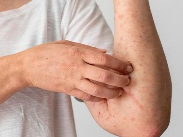 5. మంకీపాక్స్, చికెన్‌పాక్స్ దద్దుర్లు ఎలా ఉంటాయి