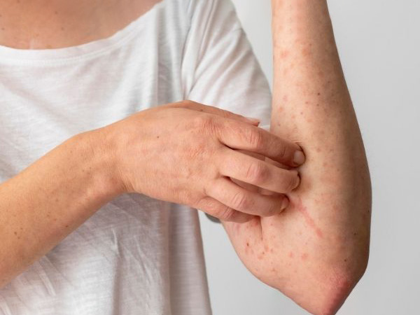 మంకీపాక్స్ అంటే ఏంటి?