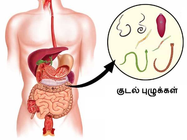 6. పేగు పురుగులు