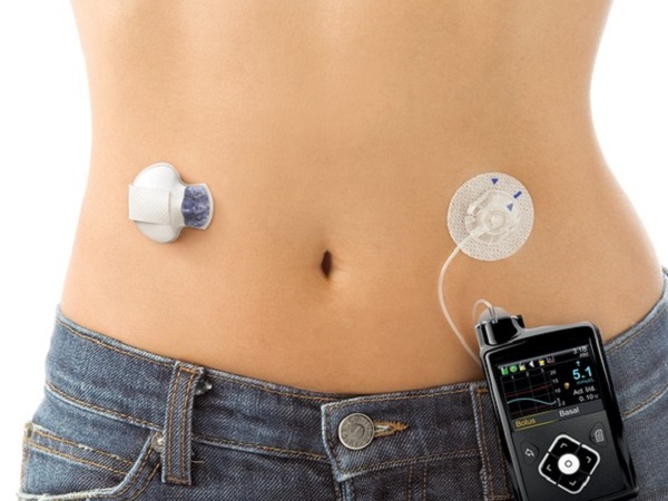 ఇన్సులిన్ పంప్ ఉపయోగించడం