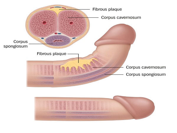 పెరోనీ వ్యాధి అంటే ఏమిటి? పెరోనీ వ్యాధి అంటే ఏమిటి?