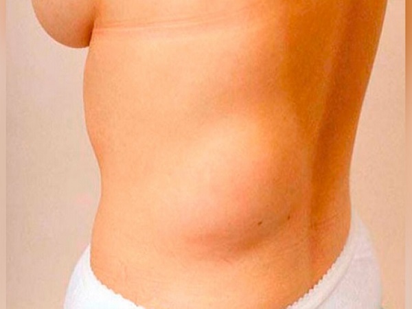 లిపోమా అంటే ఏమిటి? లిపోమా అంటే ఏమిటి?