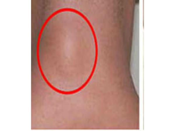 లిపోమాలు ఎంత సాధారణమైనవి? లిపోమాలు ఎంత సాధారణమైనవి?