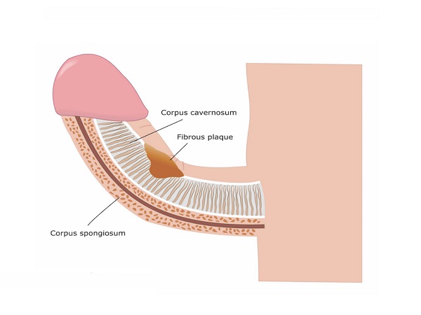 పెరోనీ వ్యాధి, పురుషాంగం వక్రత మధ్య తేడా ఏమిటి? పెరోనీ వ్యాధి, పురుషాంగం వక్రత మధ్య తేడా ఏమిటి?