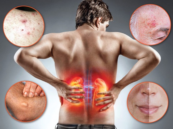 మూత్రపిండాల వ్యాధి యొక్క లక్షణాలు