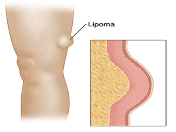 What is Lipoma? Know Causes, Symptoms, Types, Treatment in Telugu What is Lipoma? Know Causes, Symptoms, Types, Treatment in Telugu