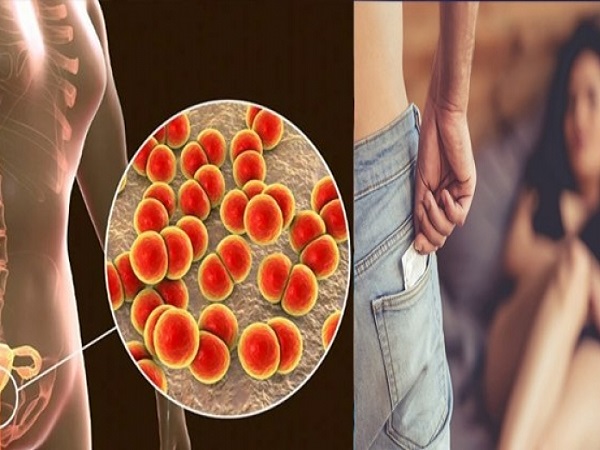 ఏయే పరీక్షల ద్వారా గనేరియాను నిర్ధారించవచ్చు: ఏయే పరీక్షల ద్వారా గనేరియాను నిర్ధారించవచ్చు: